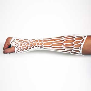 3D printed cast on arm